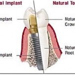 Dental Implants Lake County Florida Dental Implants Lake County Florida