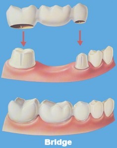 Dental Implants Lake County Florida Dental Implants Lake County Florida