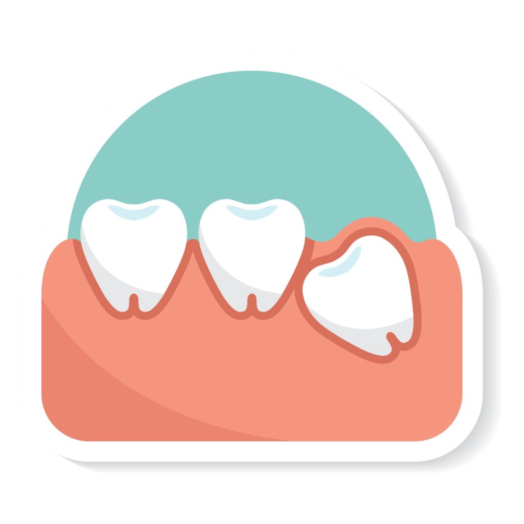 Impacted wisdom teeth can be caused by lack of jaw space, the angle the tooth is growing and more.