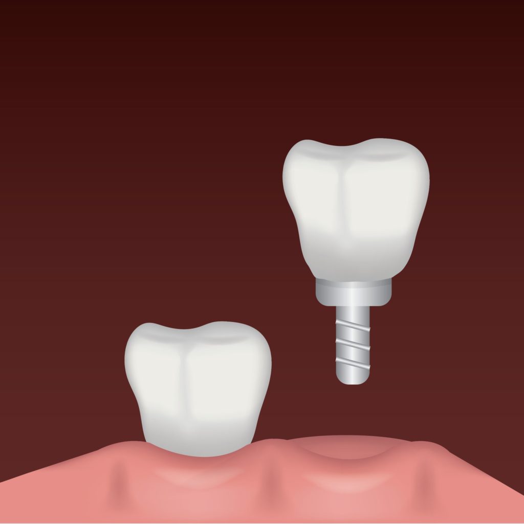 Dental implants are part of restorative dentistry.