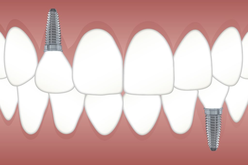 Dental Implants are a more permanent solution than dentures and can look and work like normal teeth.