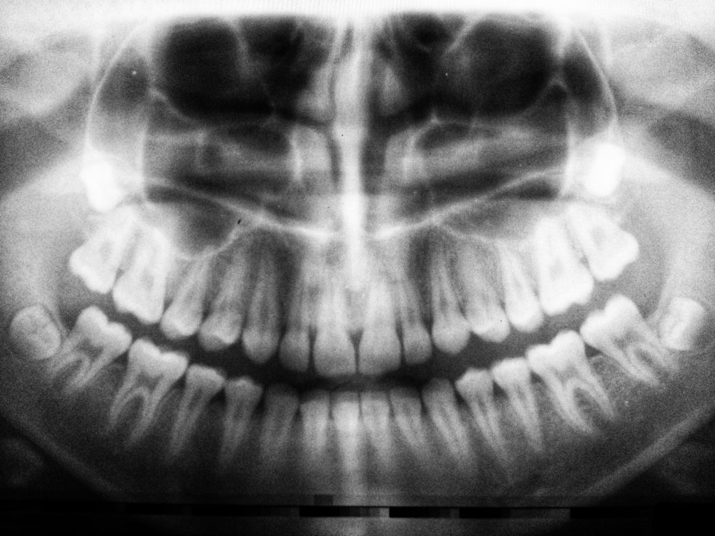 Having impacted wisdom teeth can lead to tooth misalignment.