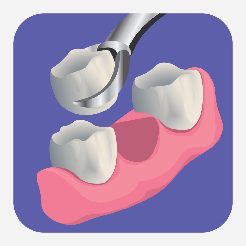 Dental extractions can help ease pain from unhealthy teeth.