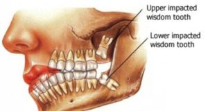 Things To Know Before Wisdom Teeth Removal In Clermont Fl